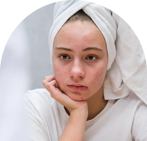 La Vie MD: Acne_Scar_About La Vie MD: Acne_Scar_About