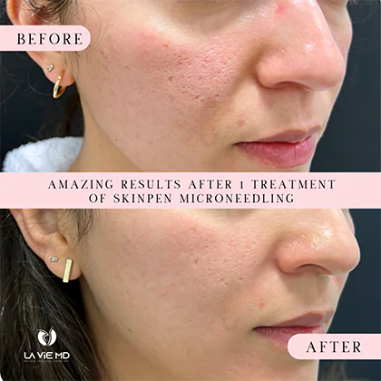 La Vie MD: Microneedling-before-after-1 La Vie MD: Microneedling-before-after-1