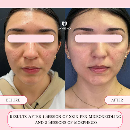 La Vie MD: Microneedling-before-after-2 La Vie MD: Microneedling-before-after-2