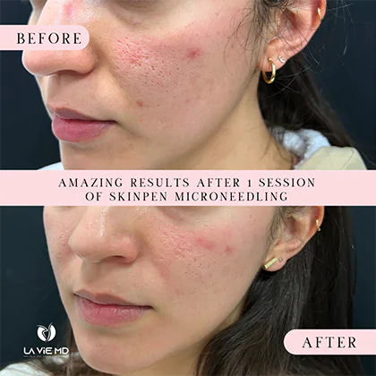 La Vie MD: Microneedling-before-after-3 La Vie MD: Microneedling-before-after-3