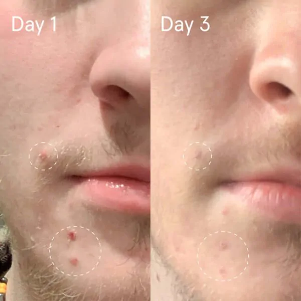 La Vie MD: Sulfur_Spot_Treatment4