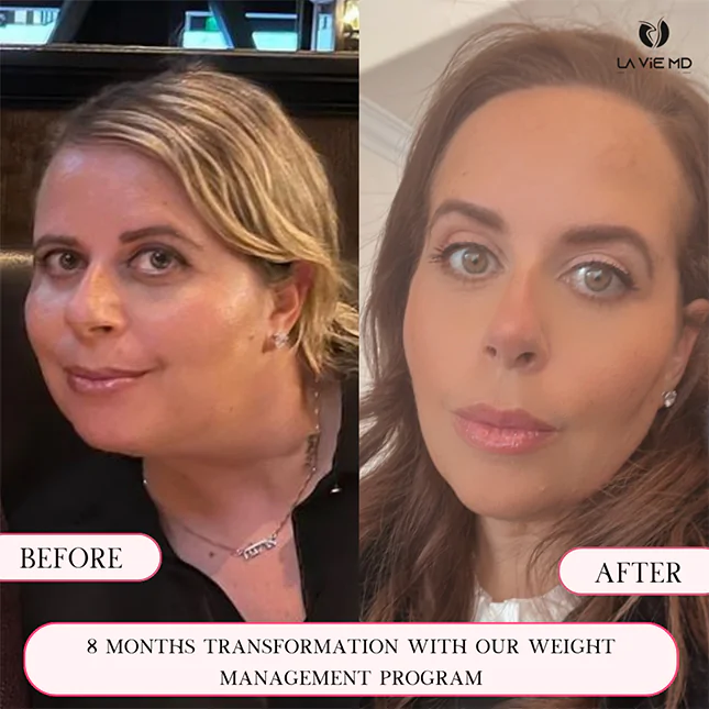 La Vie MD: semaglutide-before-after-1 La Vie MD: semaglutide-before-after-1