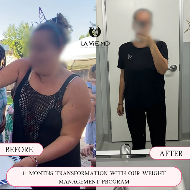 La Vie MD: semaglutide-before-after-2 La Vie MD: semaglutide-before-after-2