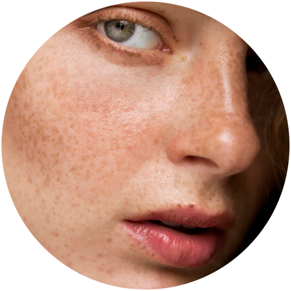 La Vie MD: Melasma La Vie MD: Melasma
