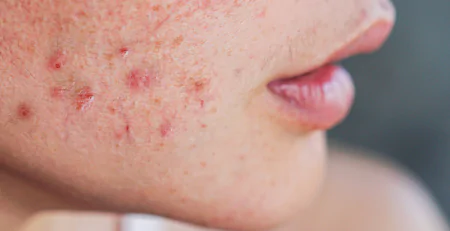 Adult Acne Treatments: Proven Strategies and Practical Tips