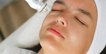 Post-Treatment Care for Acne Laser Treatment