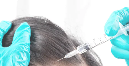 Top Benefits of PRP Hair Treatment: Is It Right for You? (Expert Recommendations)