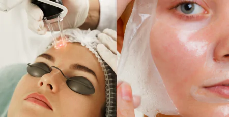 Laser Skin Resurfacing vs. Chemical Peels: Which One is Better for You?