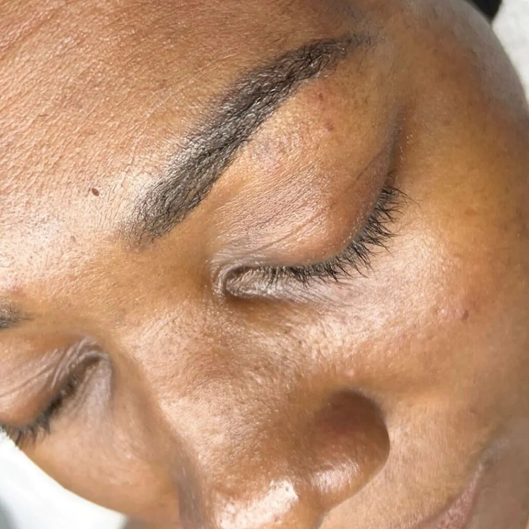 Skin Rejuvenation Treatments 2 skin rejuvenation before 1