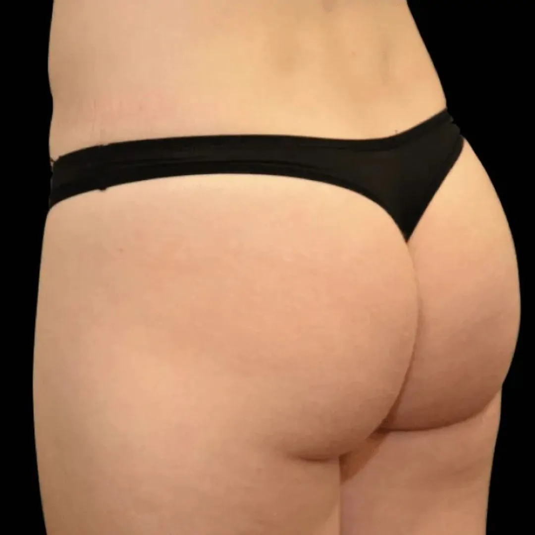 Body Contouring 11 Body Contouring