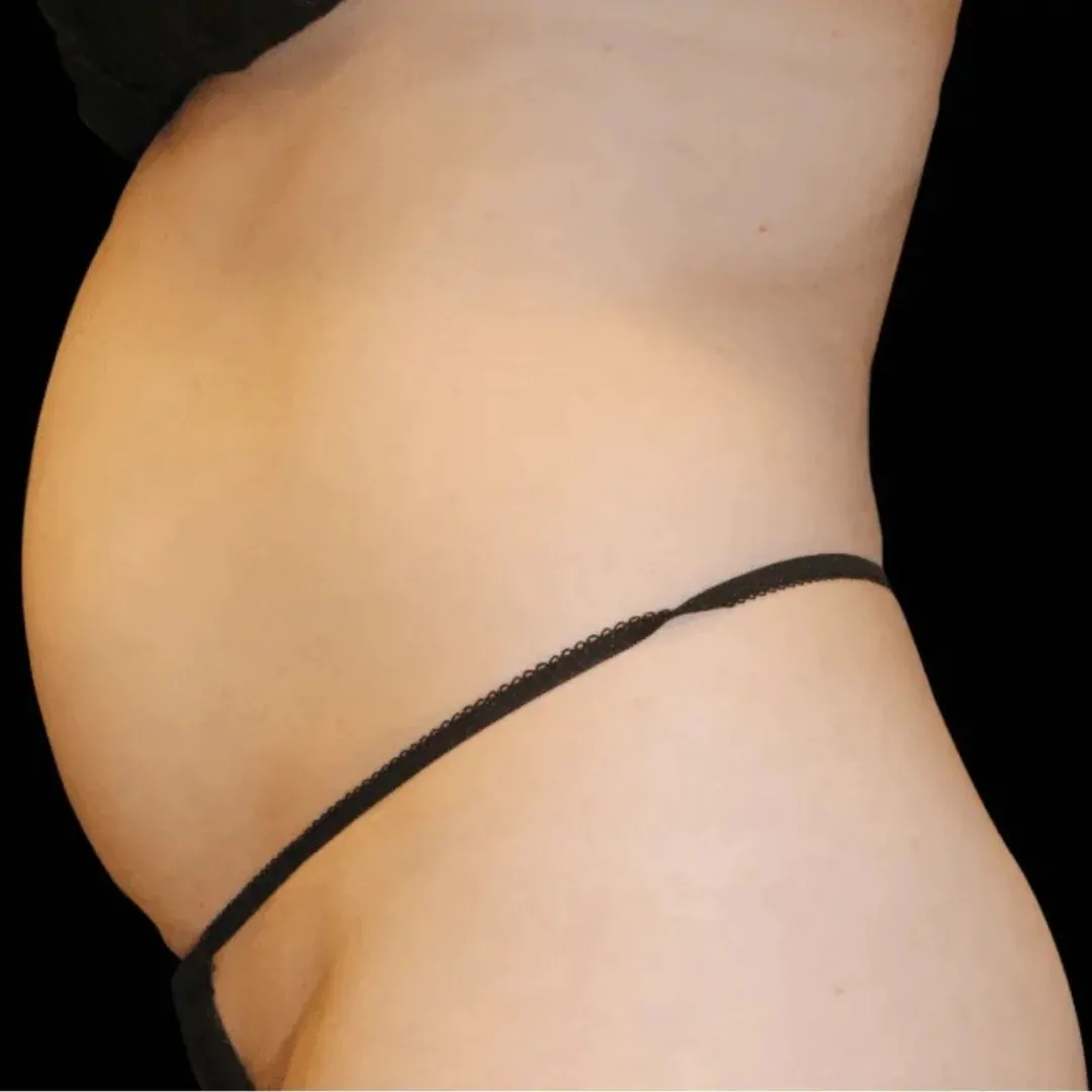Body Contouring 12 Body Contouring