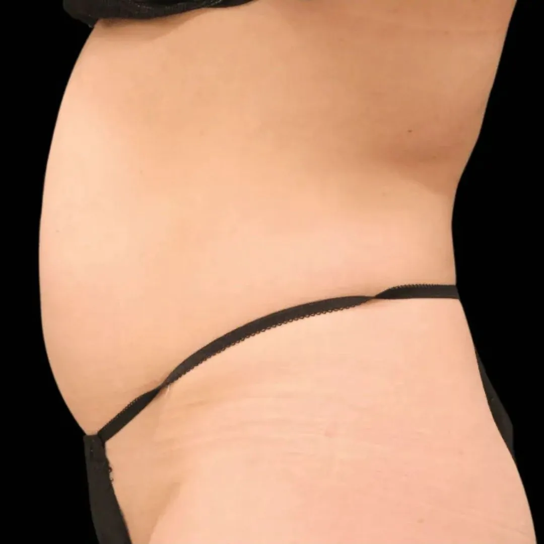 Body Contouring 13 Body Contouring