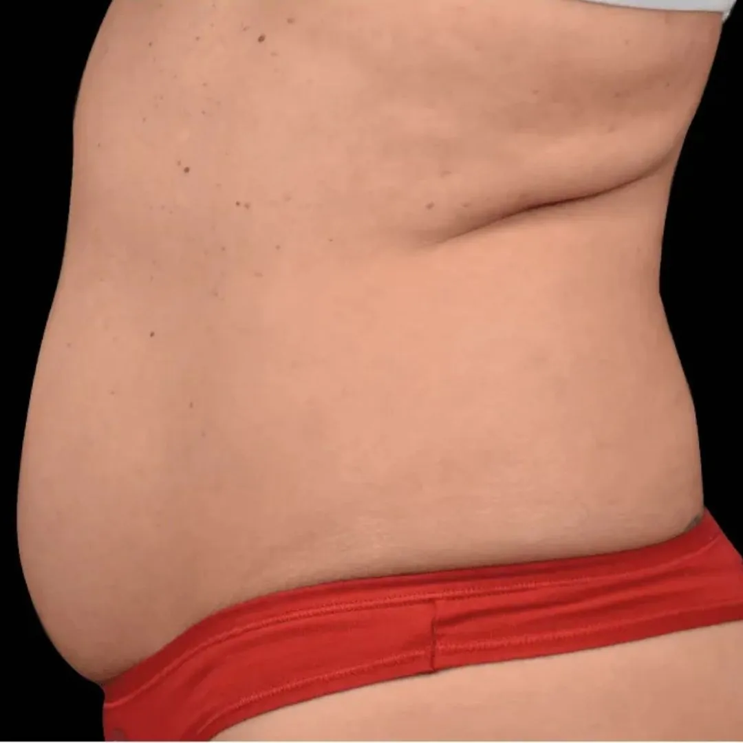 Body Contouring 2 Body Contouring