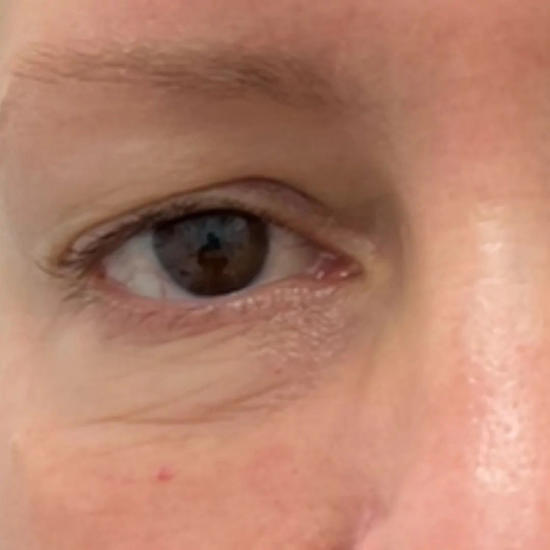 Exosome Therapy at LA ViE MD 2 Exosome before