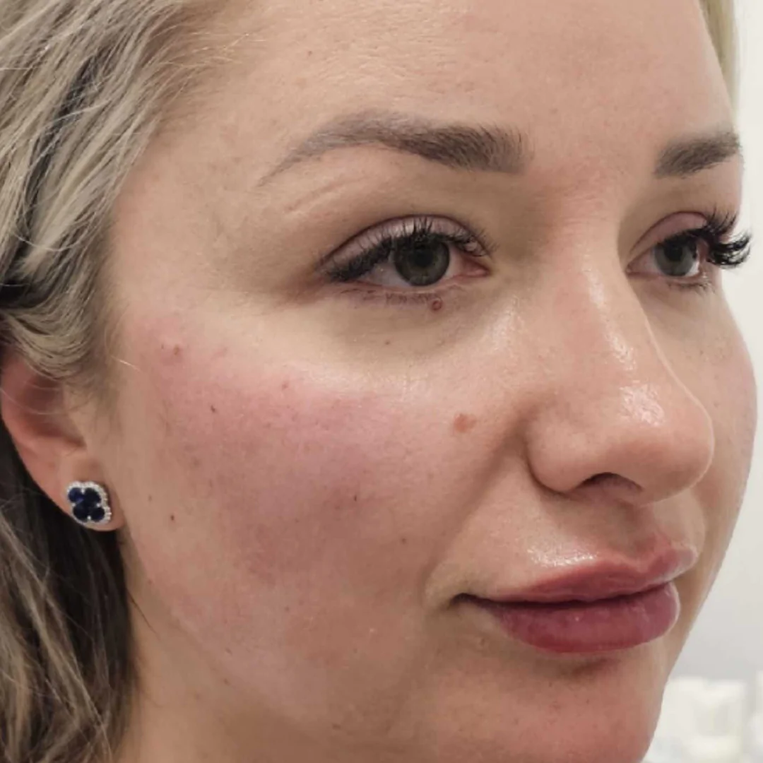 Dermal Fillers at LA ViE MD | Restore Lost Volume 11 Dermal Fillers at LA ViE MD | Restore Lost Volume