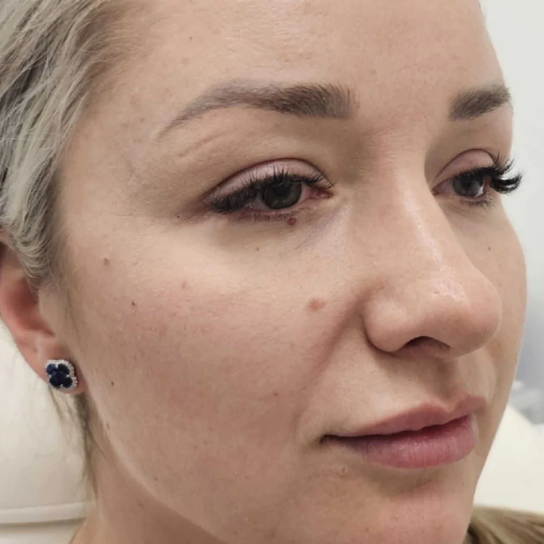 Dermal Fillers at LA ViE MD | Restore Lost Volume 10 Dermal Fillers at LA ViE MD | Restore Lost Volume