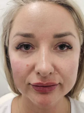 Dermal Fillers at LA ViE MD | Restore Lost Volume