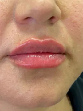Dermal Fillers at LA ViE MD | Restore Lost Volume