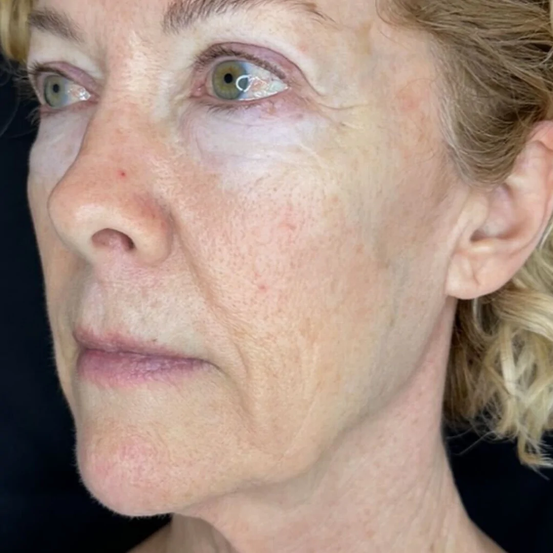 Morpheus8 Skin Tightening at LA ViE MD | Body Contouring 10 Morpheus8 Skin Tightening at LA ViE MD | Body Contouring