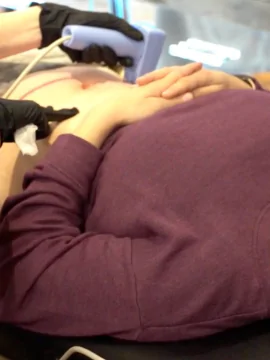 Morpheus8 Skin Tightening at LA ViE MD | Body Contouring